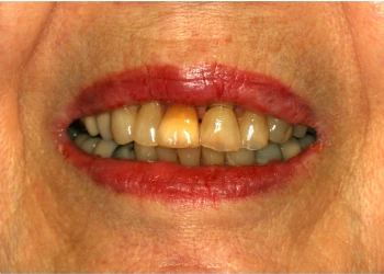 Close-up of a person's mouth showing stained and discolored teeth with red lipstick.