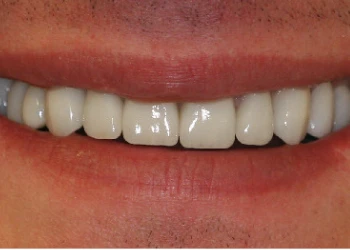Close-up of a smiling mouth with clean, white, evenly spaced teeth.
