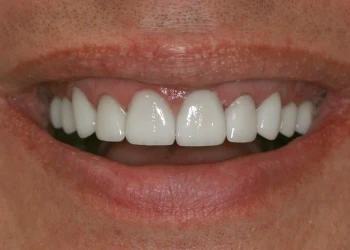 Close-up of a smile showing a set of white, straight upper teeth and lips.