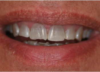 Close-up of a person's mouth showing chipped front teeth and lips with natural skin texture.