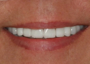 Close-up of a smiling mouth showing clean, evenly aligned white teeth.