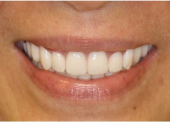 Close-up of a smiling mouth showing white, straight teeth and natural lips.