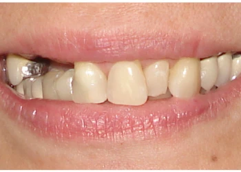 Close-up of a person's mouth with slightly uneven upper front teeth and a missing side tooth filled with a metal dental crown.