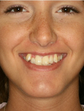 Close-up of a smiling woman with visible upper teeth and light freckles on her face.