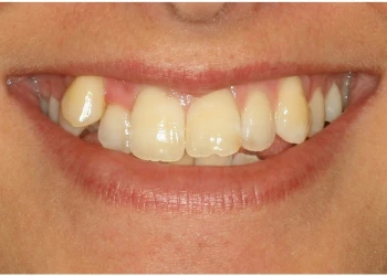 Close-up of a person's smile showing upper teeth with gaps and uneven alignment.