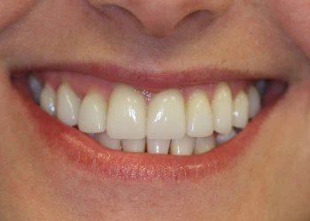 Close-up of a smile showing clean, well-aligned upper and lower teeth.