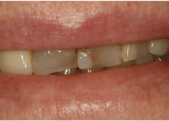 Close-up of partially closed lips showing stained and chipped upper front teeth.