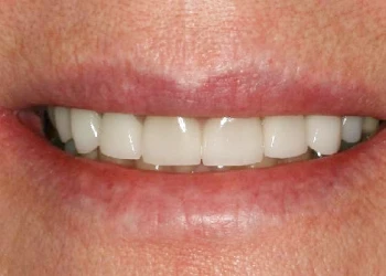Close-up of a person’s mouth smiling, showing clean, white teeth and natural lips.