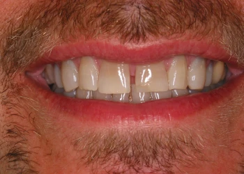 Close-up of a person's mouth smiling, showing natural teeth with slight discoloration and facial hair around the lips.