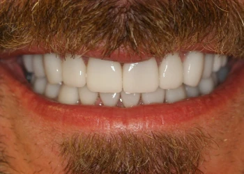 Close-up of a smiling mouth showing clean, white teeth and a mustache and beard around the lips.