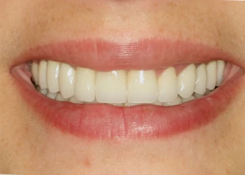 Close-up of a person's mouth smiling with straight, white teeth and natural lips.