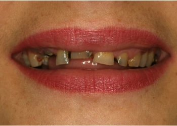 Close-up of a mouth with severely decayed and missing teeth and pink lipstick.