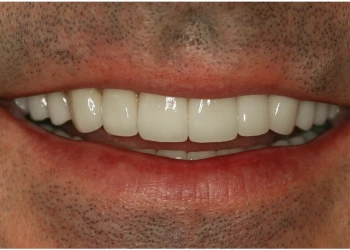 Close-up of a smiling person's mouth showing white, evenly aligned teeth and natural skin with facial hair stubble.