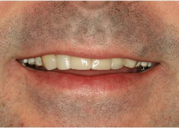 Close-up of a man's mouth with a slight smile showing teeth and facial stubble.