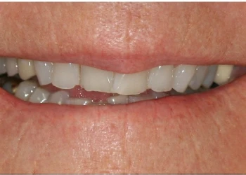 Close-up of a person's mouth showing slightly parted lips and upper and lower teeth with visible gaps and uneven edges.