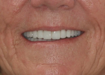 Close-up of an elderly person's mouth showing white, even teeth and wrinkled skin.