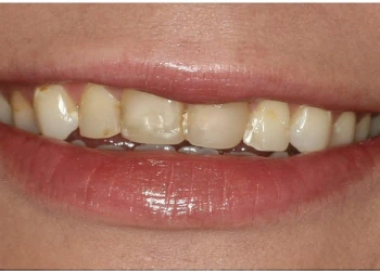 Close-up of a person's smile showing stained and uneven upper front teeth.