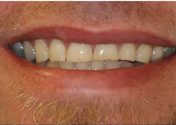Close-up of a person's mouth showing slightly parted lips and upper and lower teeth.