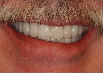 Close-up of a smiling mouth with white dental prosthetic teeth and a mustache.