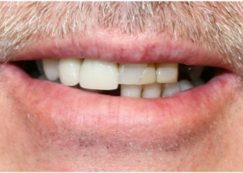 Close-up of a mouth with upper front teeth showing discoloration and dental restorations.