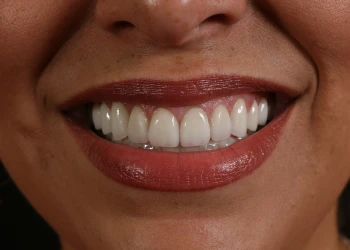 Close-up of a smiling person with well-aligned white teeth and wearing red lipstick.
