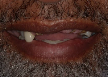 Close-up of a smiling mouth with missing and uneven teeth surrounded by a gray beard and mustache.