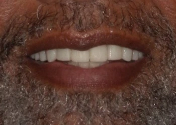 Close-up of a smiling mouth with white teeth and a dark beard.