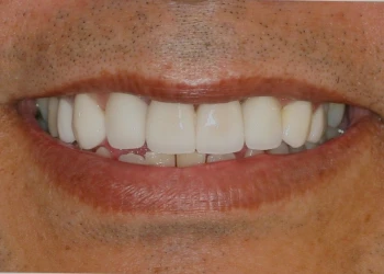 Close-up of a person's mouth smiling, showing upper teeth with dental veneers or crowns.
