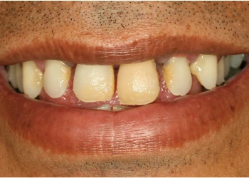 Close-up of a smile showing teeth with gaps and some yellow discoloration.