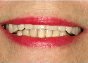 Close-up of a person's mouth showing teeth with red lipstick applied around the lips.