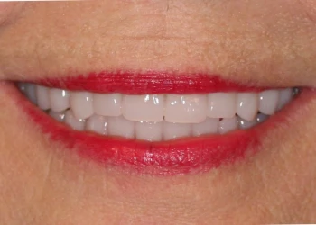 Close-up of a smiling mouth with white teeth and red lipstick on lips.