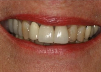 Close-up of a smiling mouth showing uneven and discolored teeth.