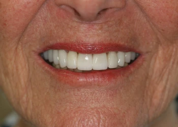 Close-up of a smiling older person's mouth showing white upper teeth and red lipstick.
