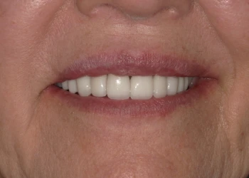Close-up of a smiling mouth with white, evenly spaced teeth and natural lip texture.
