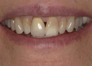 Close-up of a person's smile showing discolored front teeth with visible stains and some dental wear.