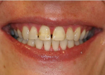 Close-up of a smiling mouth showing teeth with discoloration and slight gaps.