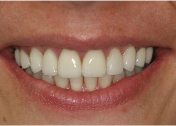 Close-up of a smile showing white, well-aligned teeth and natural lips.