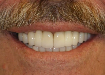 Close-up of a man's mouth with a mustache showing a bright smile with evenly aligned teeth.