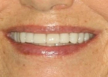 Close-up of a smile showing well-aligned white teeth and natural lips.