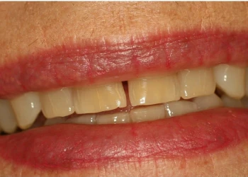 Close-up of lips and upper front teeth showing a gap between two yellowed teeth.