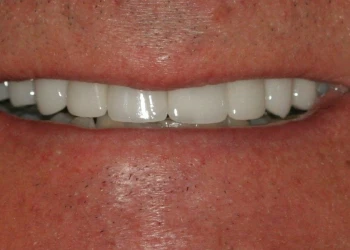 Close-up of a person’s mouth showing a smile with white, evenly aligned teeth and slightly tanned skin.