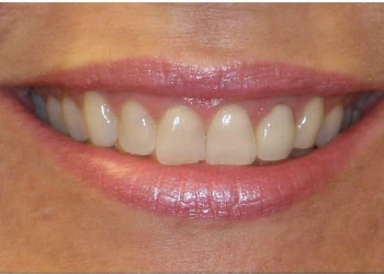 Close-up of a smiling mouth showing clean, straight teeth and pink lips.