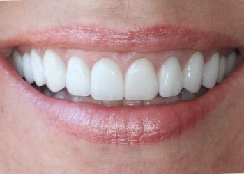 Close-up of a smiling mouth showing clean, white, evenly aligned upper teeth.