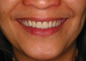 Close-up of a smiling person showing clean, white teeth.