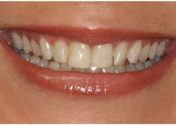 Close-up of a person smiling showing slightly uneven upper front teeth.