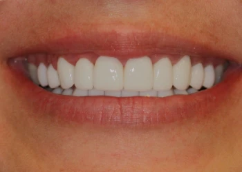 Close-up of a smiling mouth showing clean, white teeth.