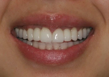 Close-up of a smiling mouth showing even, white teeth and glossy lips.