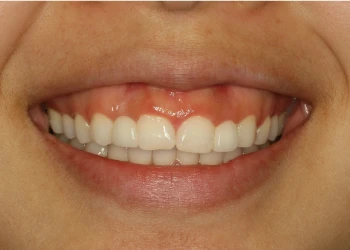 Close-up of a smiling mouth showing clean white teeth and healthy pink gums.