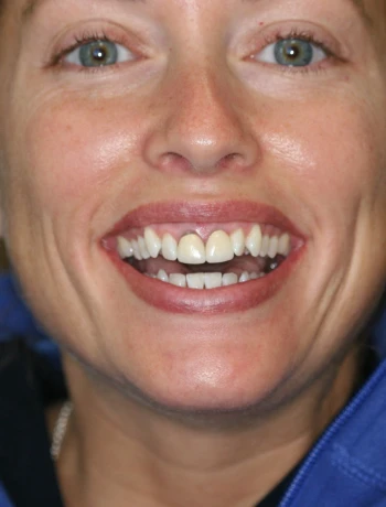 Close-up of a smiling woman showing her teeth with a noticeable yellow discoloration on one front tooth.