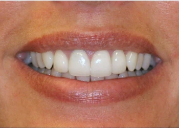 Close-up of a smiling mouth showing clean, white teeth and natural lip color.